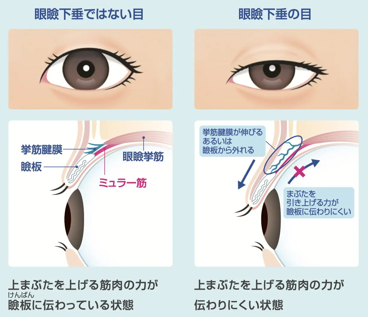 眼瞼下垂の仕組み（正常な目と眼瞼下垂の目の比較）