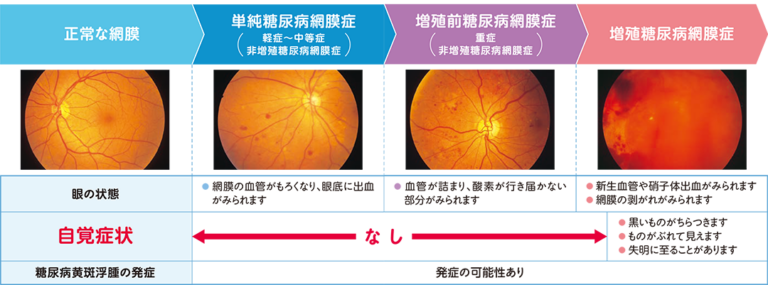 糖尿病網膜症について