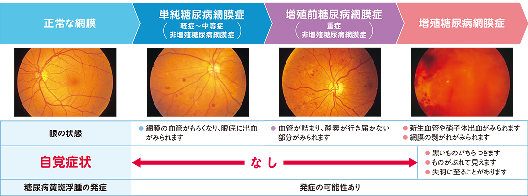 糖尿病網膜症について