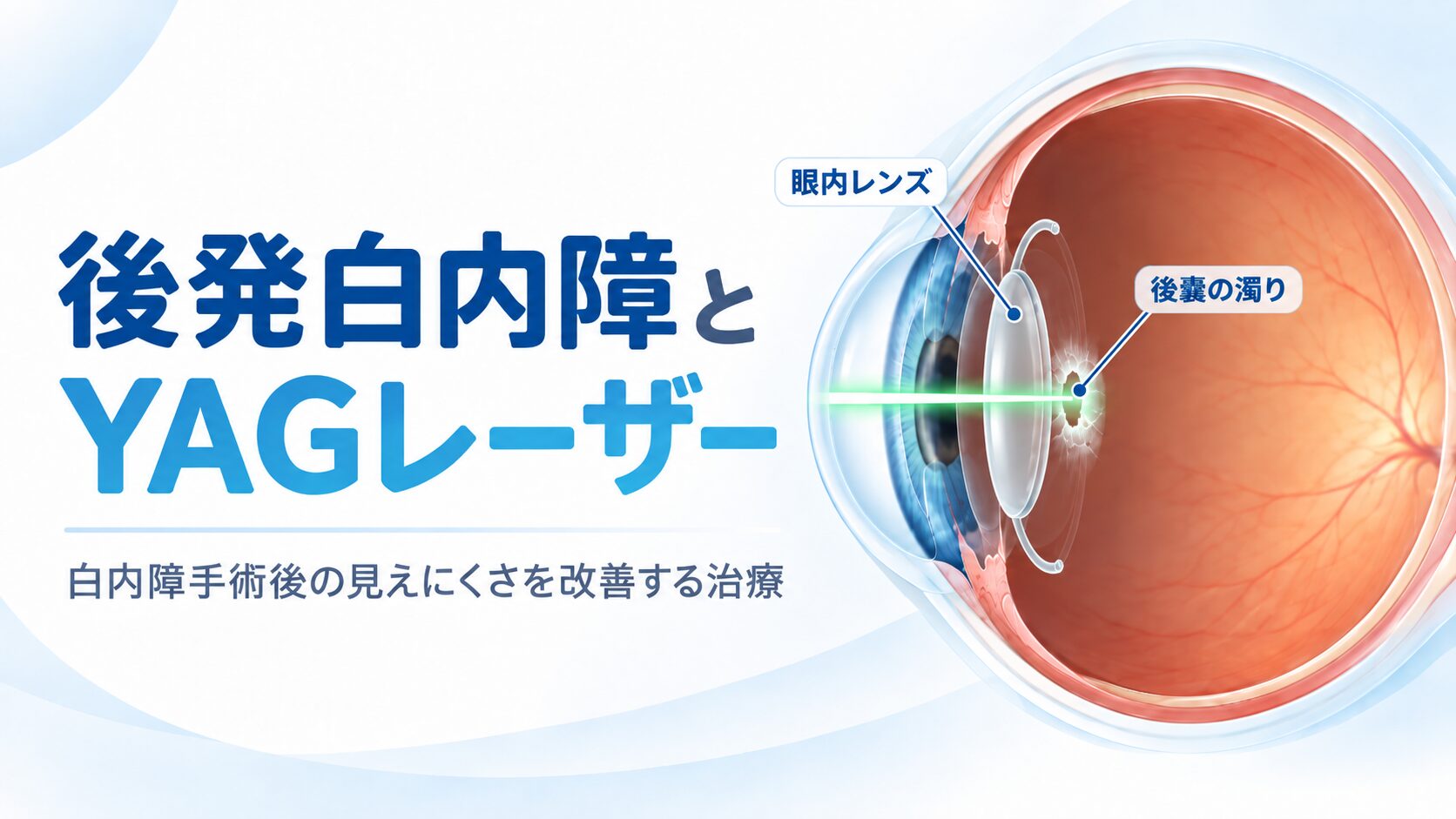 後発 性 白内障 レーザー