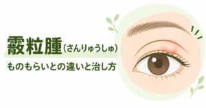 霰粒腫（さんりゅうしゅ）の治し方とものもらいとの違いを解説する記事のイラスト