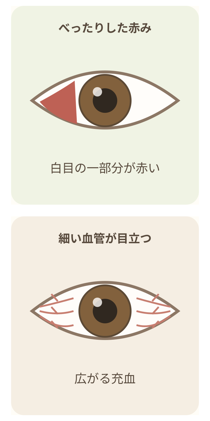 茶色い虹彩の目で、白目の限られた赤い面と、細い血管の充血を比較する模式図。